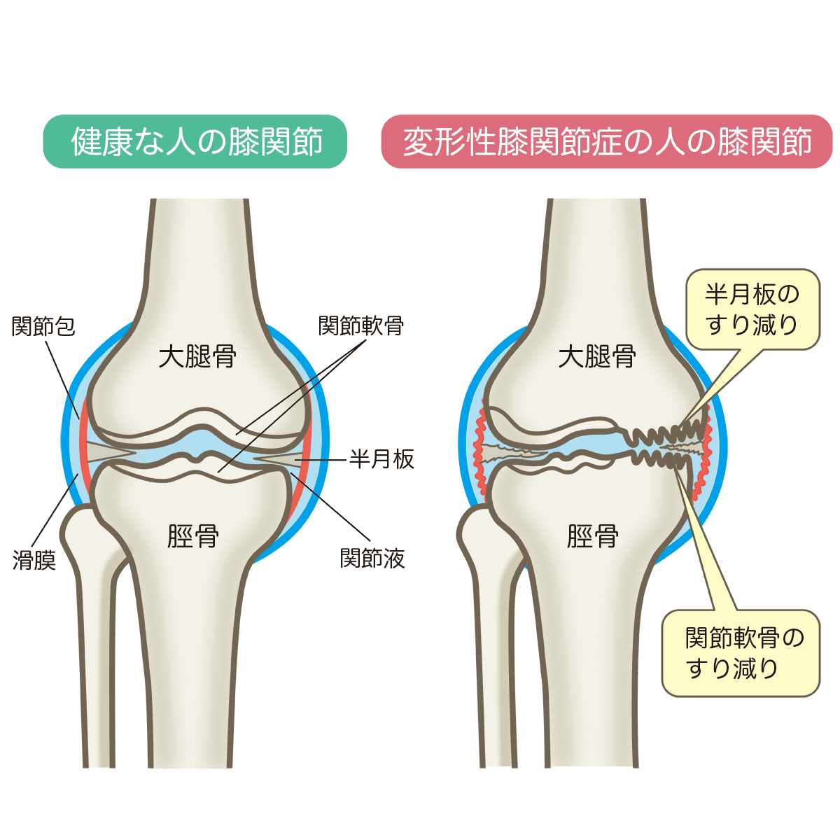 変形性膝関節症１